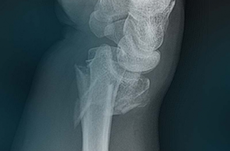 Injuries in armwrestling