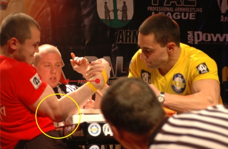 Armwrestling injury treatment – laser therapy